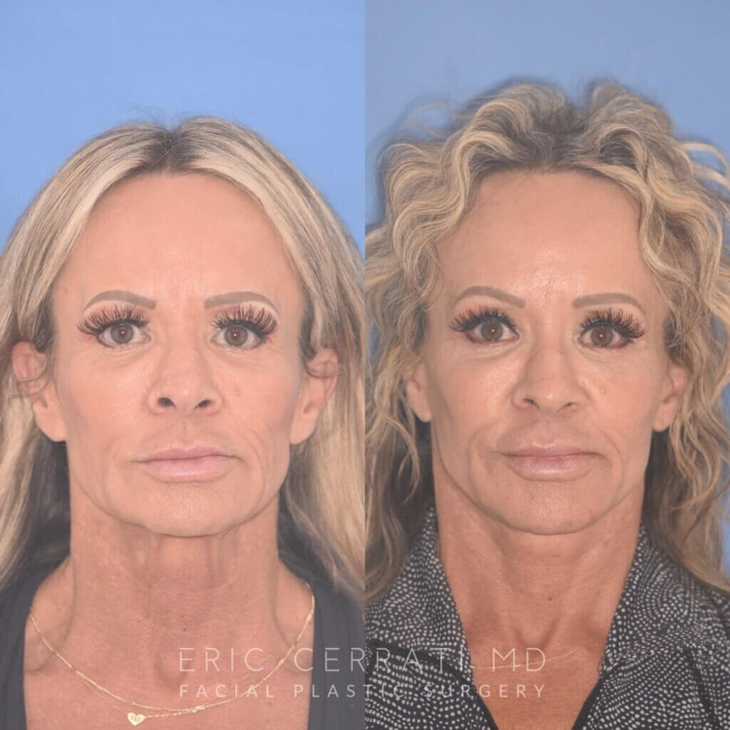 57 YR - 1 Month Postop: Endoscopic Browlift + Upper Blepharoplasty + Lower Blepharoplasty + Facelift