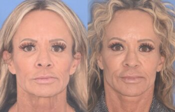57 YR - 1 Month Postop: Endoscopic Browlift + Upper Blepharoplasty + Lower Blepharoplasty + Facelift
