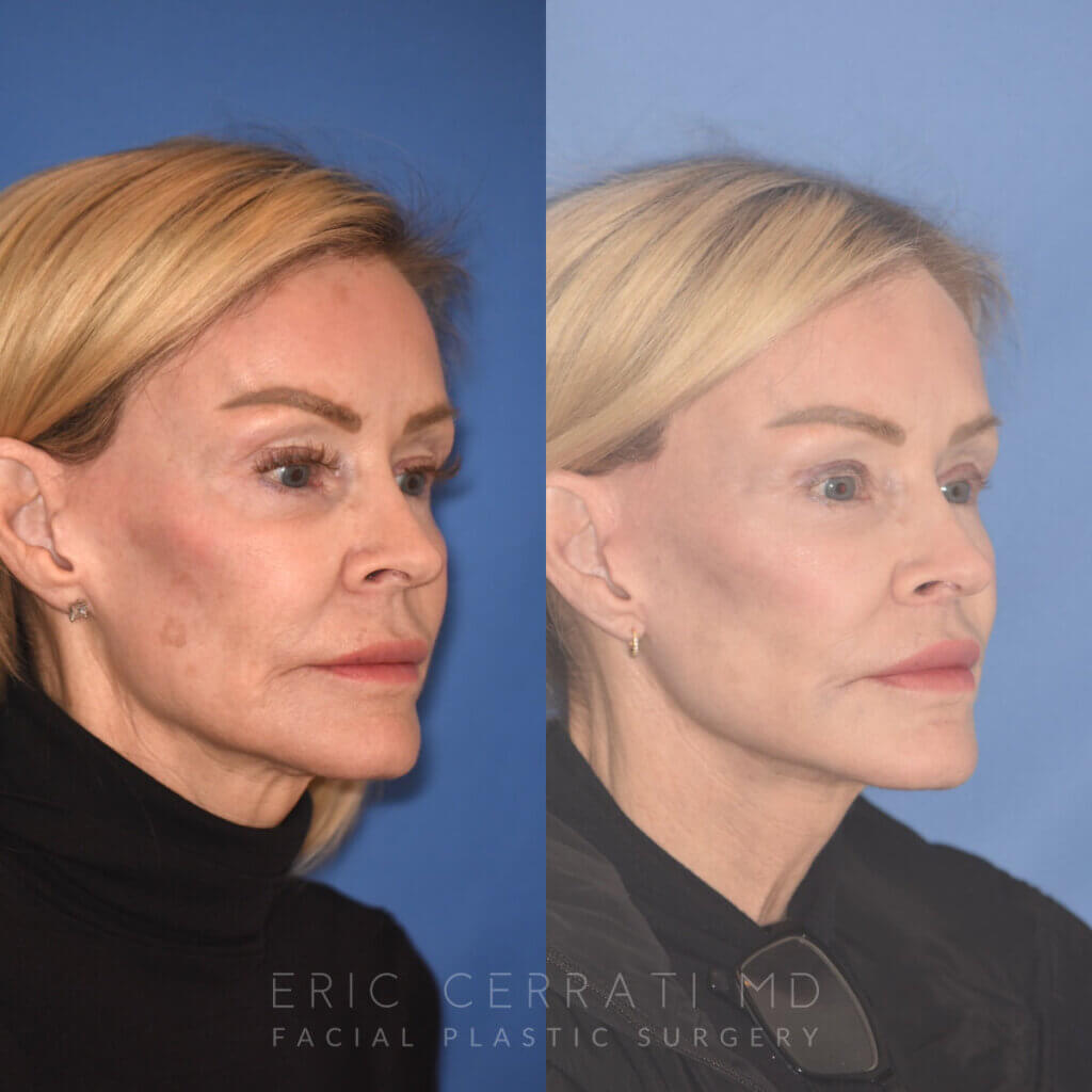 63 YR - 5 Months Postop: Revision Facelift + Revision Upper Blepharoplasty + Fat Grafting + Laser