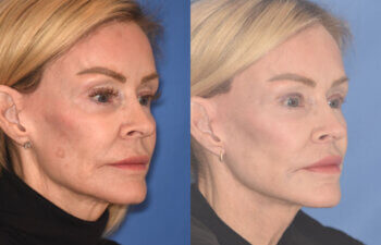 63 YR - 5 Months Postop: Revision Facelift + Revision Upper Blepharoplasty + Fat Grafting + Laser