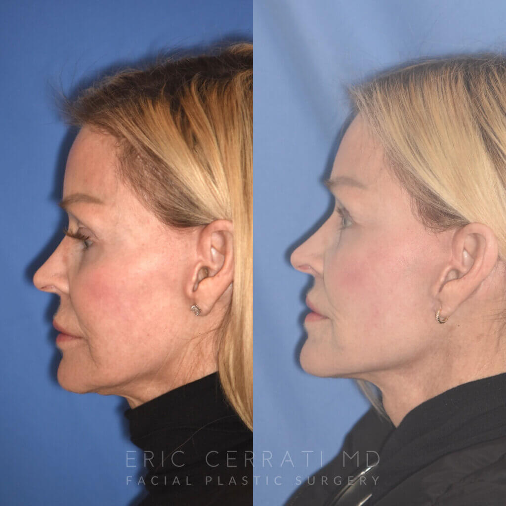 63 YR - 5 Months Postop: Revision Facelift + Revision Upper Blepharoplasty + Fat Grafting + Laser