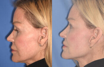 63 YR - 5 Months Postop: Revision Facelift + Revision Upper Blepharoplasty + Fat Grafting + Laser