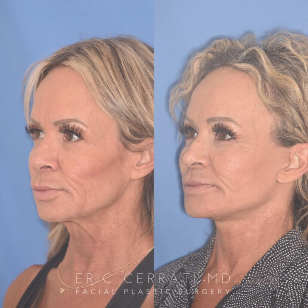 57 YR - 1 Month Postop: Endoscopic Browlift + Upper Blepharoplasty + Lower Blepharoplasty + Facelift