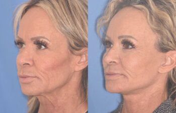 57 YR - 1 Month Postop: Endoscopic Browlift + Upper Blepharoplasty + Lower Blepharoplasty + Facelift