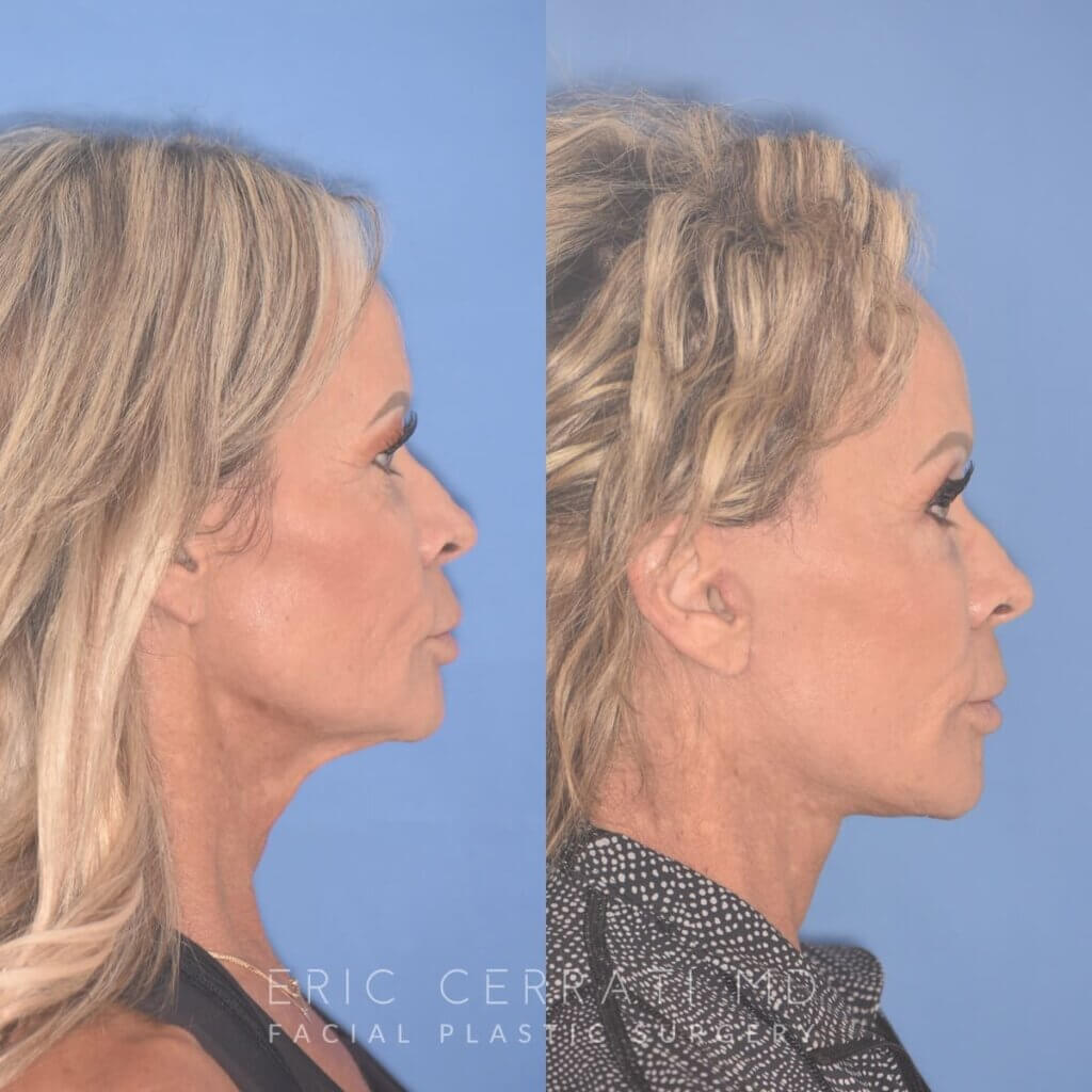 57 YR - 1 Month Postop: Endoscopic Browlift + Upper Blepharoplasty + Lower Blepharoplasty + Facelift