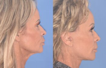 57 YR - 1 Month Postop: Endoscopic Browlift + Upper Blepharoplasty + Lower Blepharoplasty + Facelift