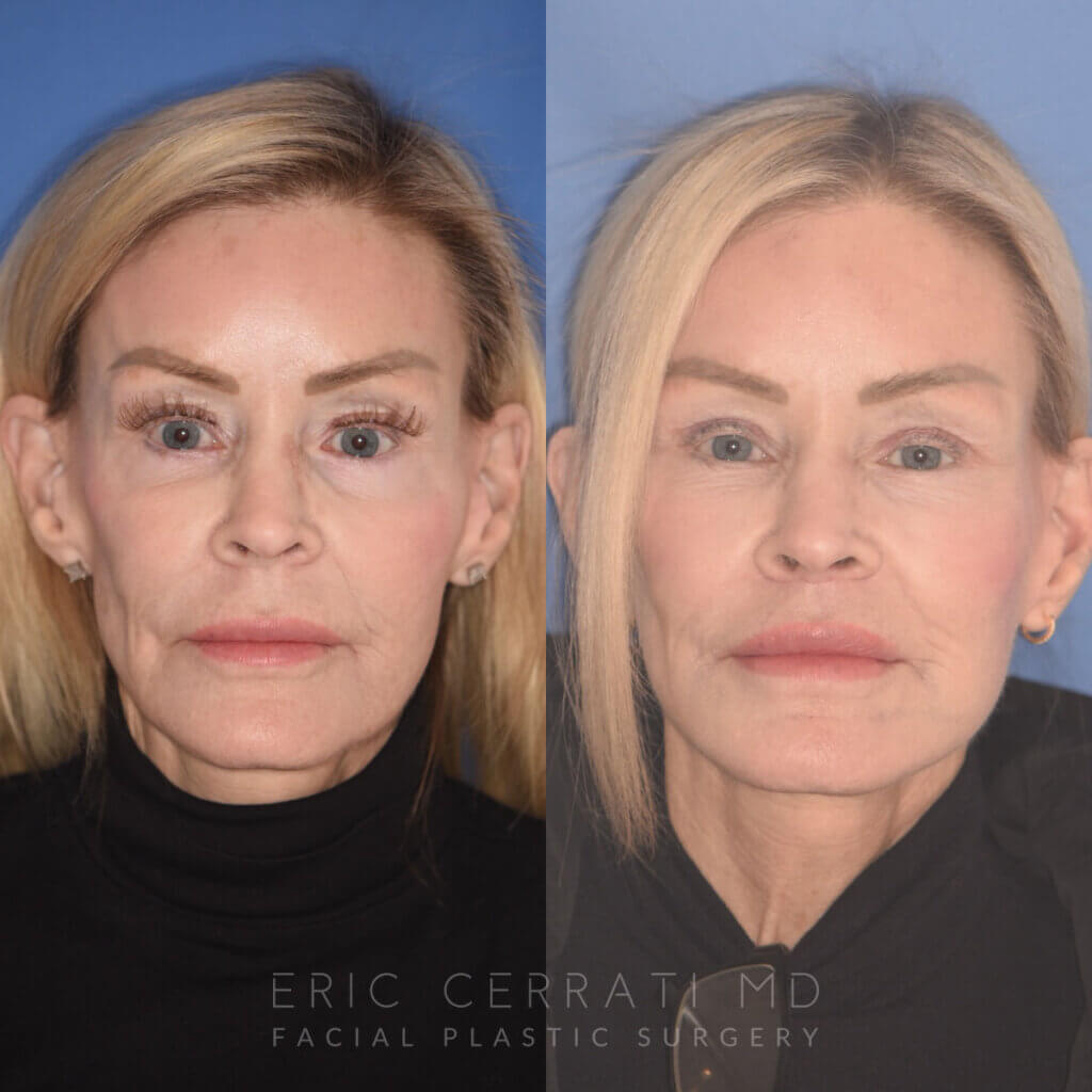 63 YR - 5 Months Postop: Revision Facelift + Revision Upper Blepharoplasty + Fat Grafting + Laser
