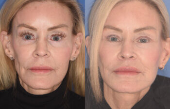 63 YR - 5 Months Postop: Revision Facelift + Revision Upper Blepharoplasty + Fat Grafting + Laser