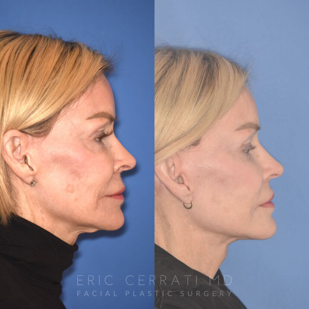 63 YR - 5 Months Postop: Revision Facelift + Revision Upper Blepharoplasty + Fat Grafting + Laser