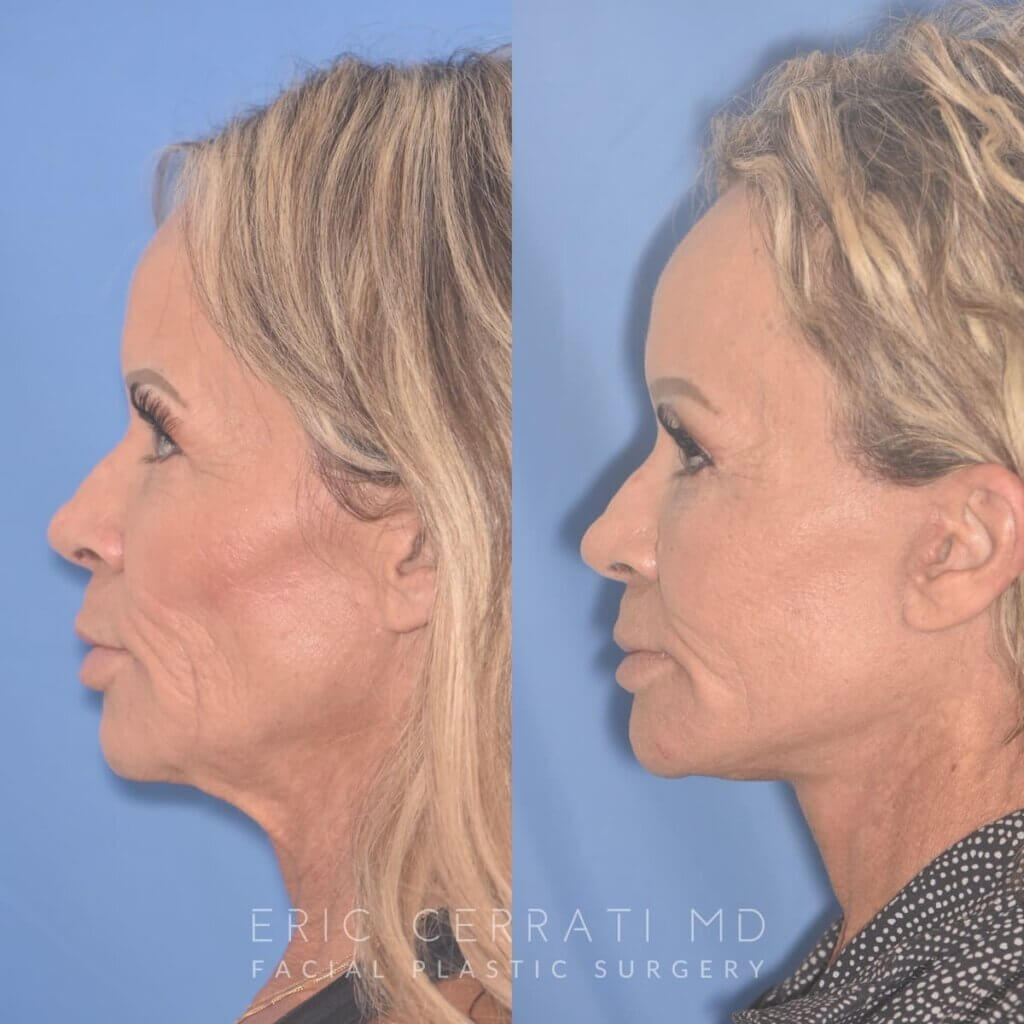 57 YR - 1 Month Postop: Endoscopic Browlift + Upper Blepharoplasty + Lower Blepharoplasty + Facelift