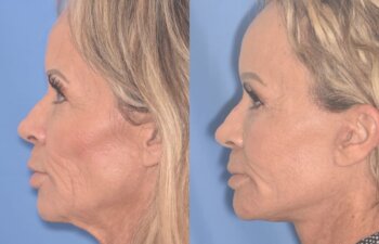 57 YR - 1 Month Postop: Endoscopic Browlift + Upper Blepharoplasty + Lower Blepharoplasty + Facelift