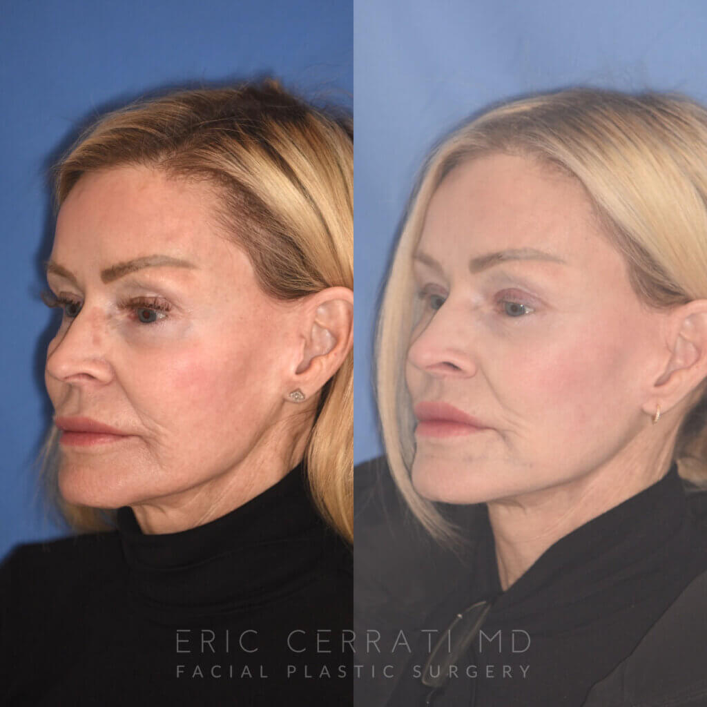 63 YR - 5 Months Postop: Revision Facelift + Revision Upper Blepharoplasty + Fat Grafting + Laser