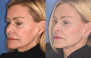 63 YR - 5 Months Postop: Revision Facelift + Revision Upper Blepharoplasty + Fat Grafting + Laser