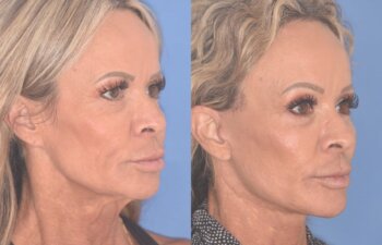 57 YR - 1 Month Postop: Endoscopic Browlift + Upper Blepharoplasty + Lower Blepharoplasty + Facelift