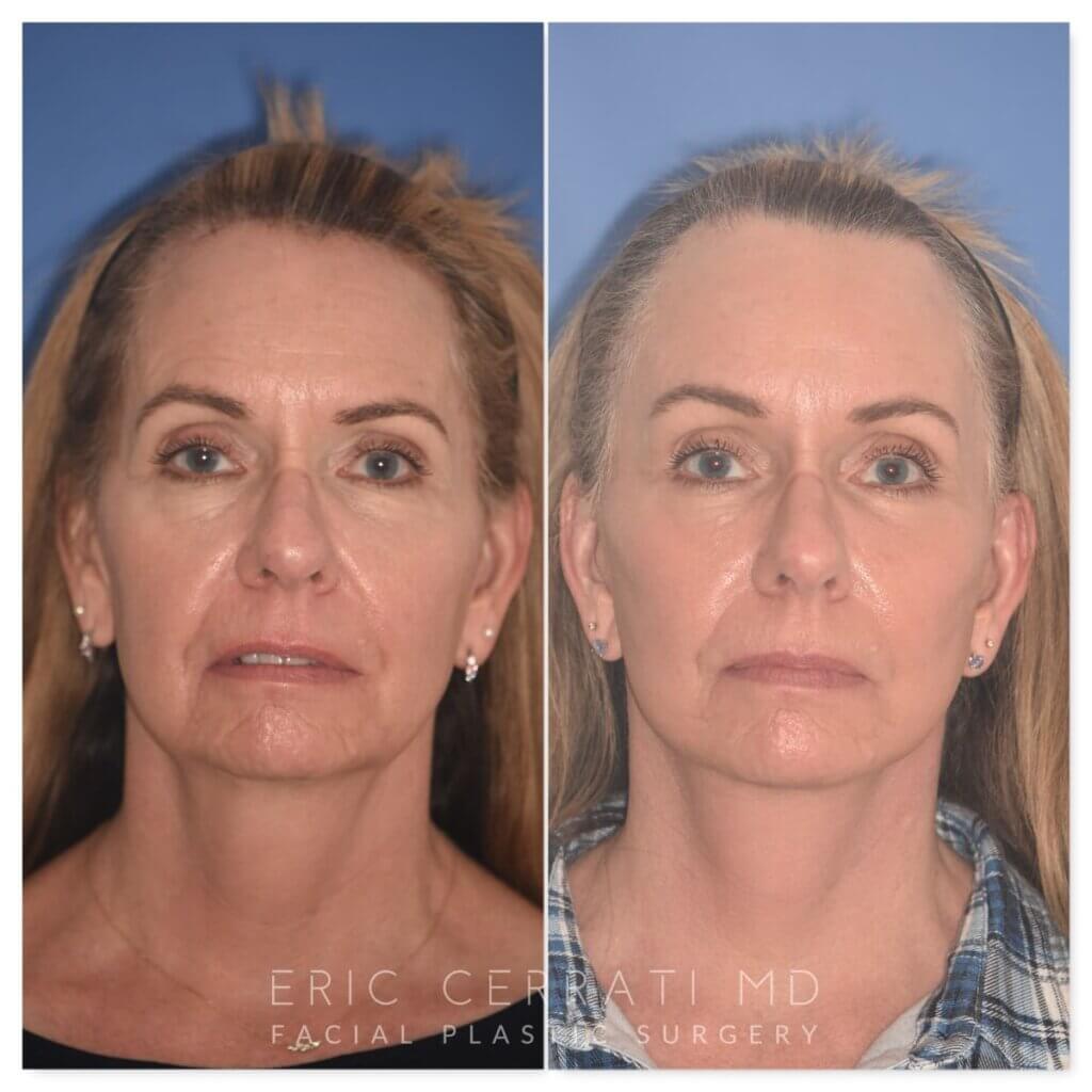 64 YR - 1 Month Postop: Endoscopic Browlift + Facelift + Lower Blepharoplasty + Buccal Fat Reduction + Fat Grafting + Laser Resurfacing