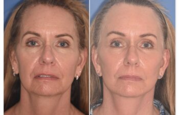 64 YR - 1 Month Postop: Endoscopic Browlift + Facelift + Lower Blepharoplasty + Buccal Fat Reduction + Fat Grafting + Laser Resurfacing