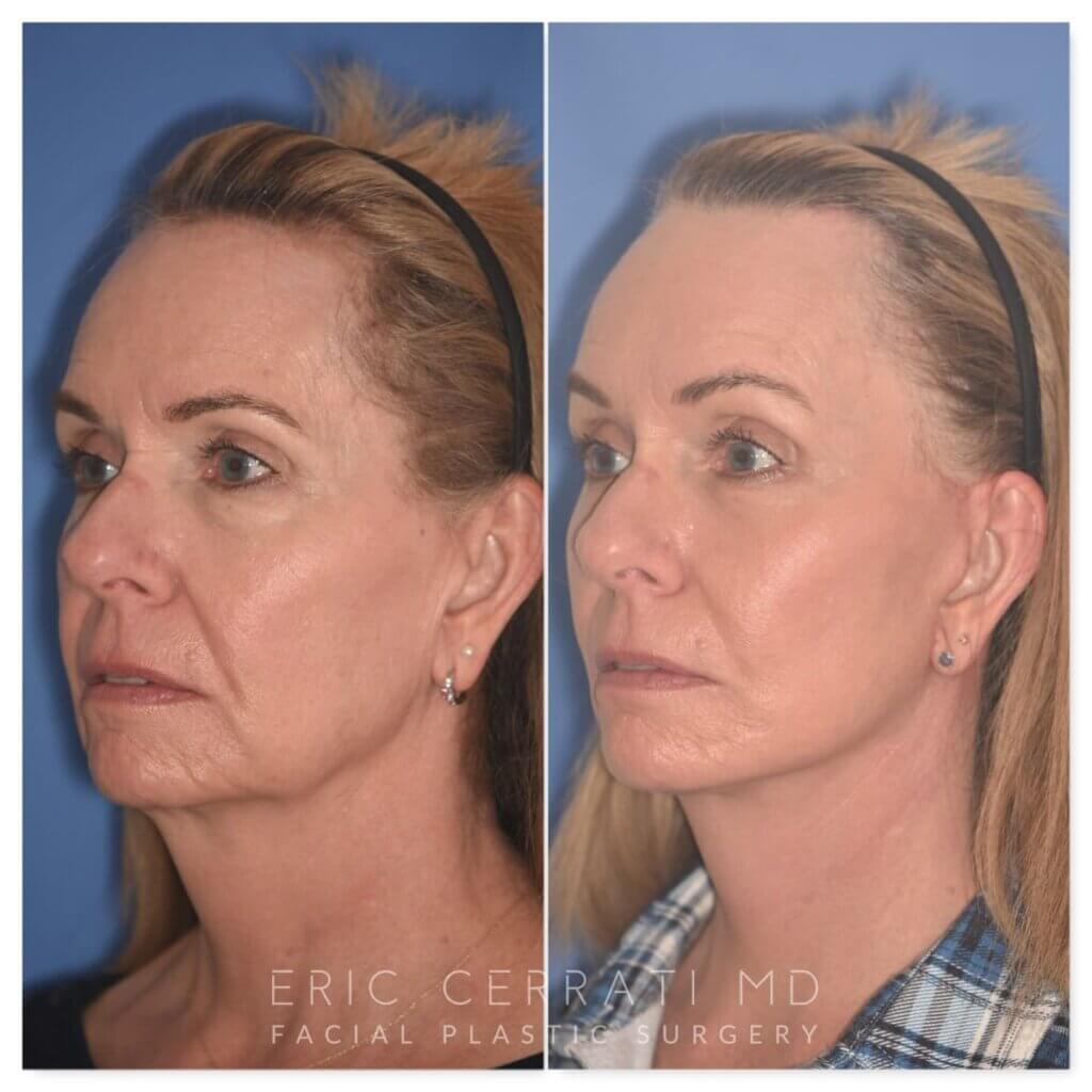 64 YR - 1 Month Postop: Endoscopic Browlift + Facelift + Lower Blepharoplasty + Buccal Fat Reduction + Fat Grafting + Laser Resurfacing