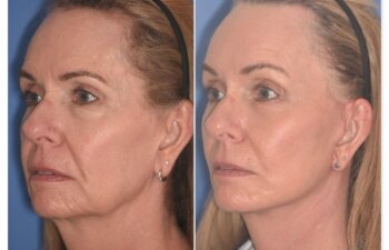 64 YR - 1 Month Postop: Endoscopic Browlift + Facelift + Lower Blepharoplasty + Buccal Fat Reduction + Fat Grafting + Laser Resurfacing