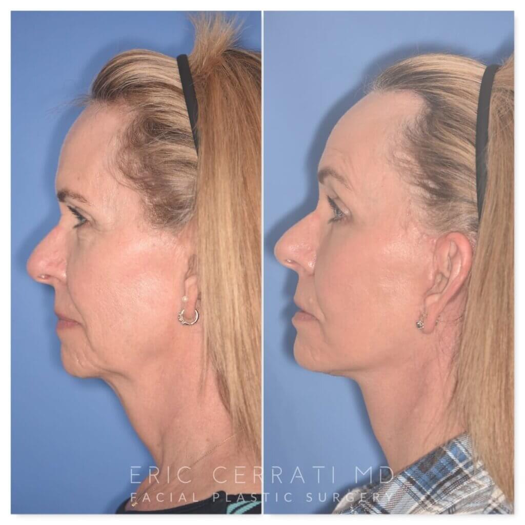 64 YR - 1 Month Postop: Endoscopic Browlift + Facelift + Lower Blepharoplasty + Buccal Fat Reduction + Fat Grafting + Laser Resurfacing