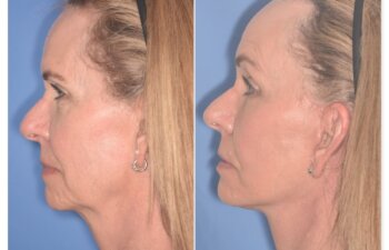 64 YR - 1 Month Postop: Endoscopic Browlift + Facelift + Lower Blepharoplasty + Buccal Fat Reduction + Fat Grafting + Laser Resurfacing