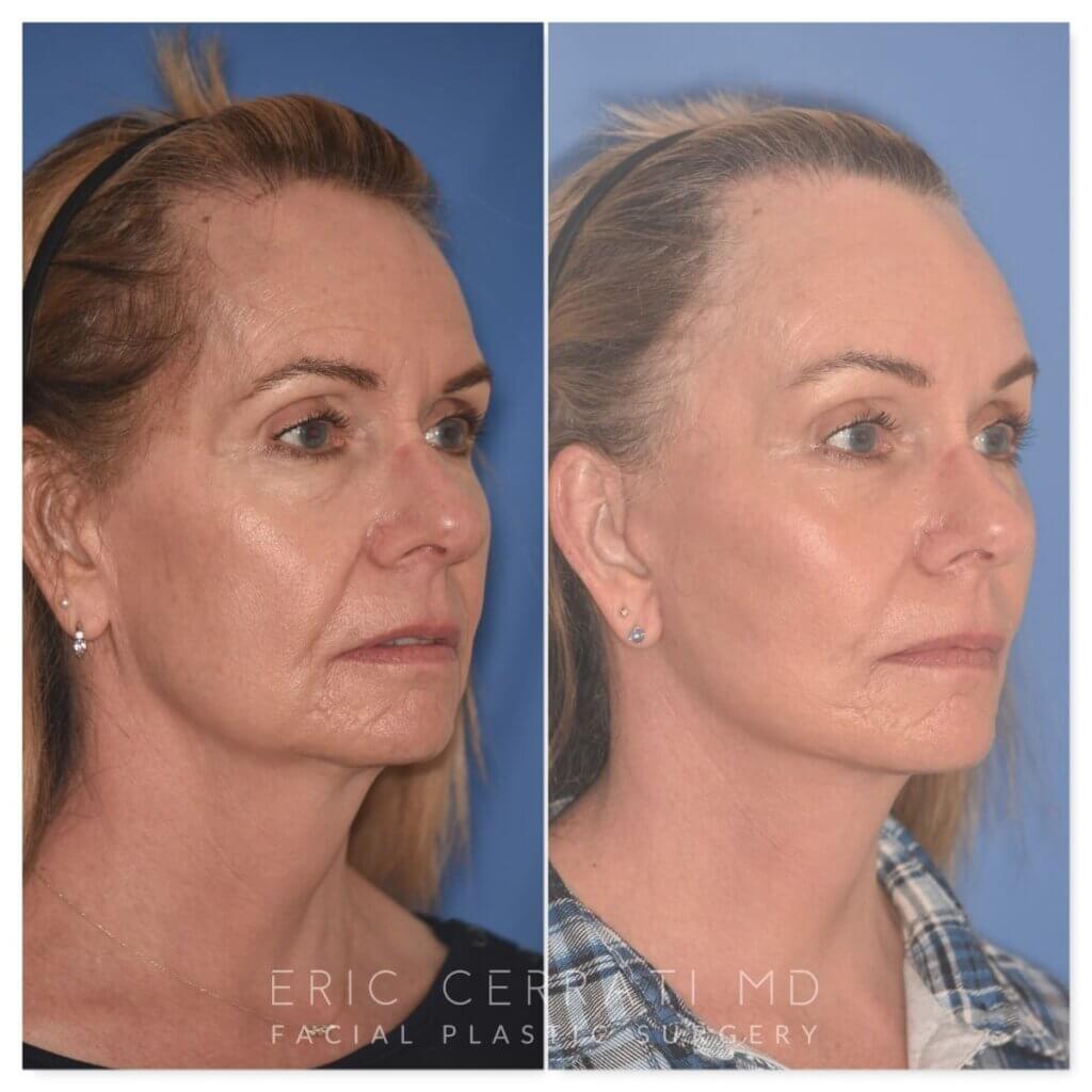 64 YR - 1 Month Postop: Endoscopic Browlift + Facelift + Lower Blepharoplasty + Buccal Fat Reduction + Fat Grafting + Laser Resurfacing