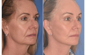 64 YR - 1 Month Postop: Endoscopic Browlift + Facelift + Lower Blepharoplasty + Buccal Fat Reduction + Fat Grafting + Laser Resurfacing