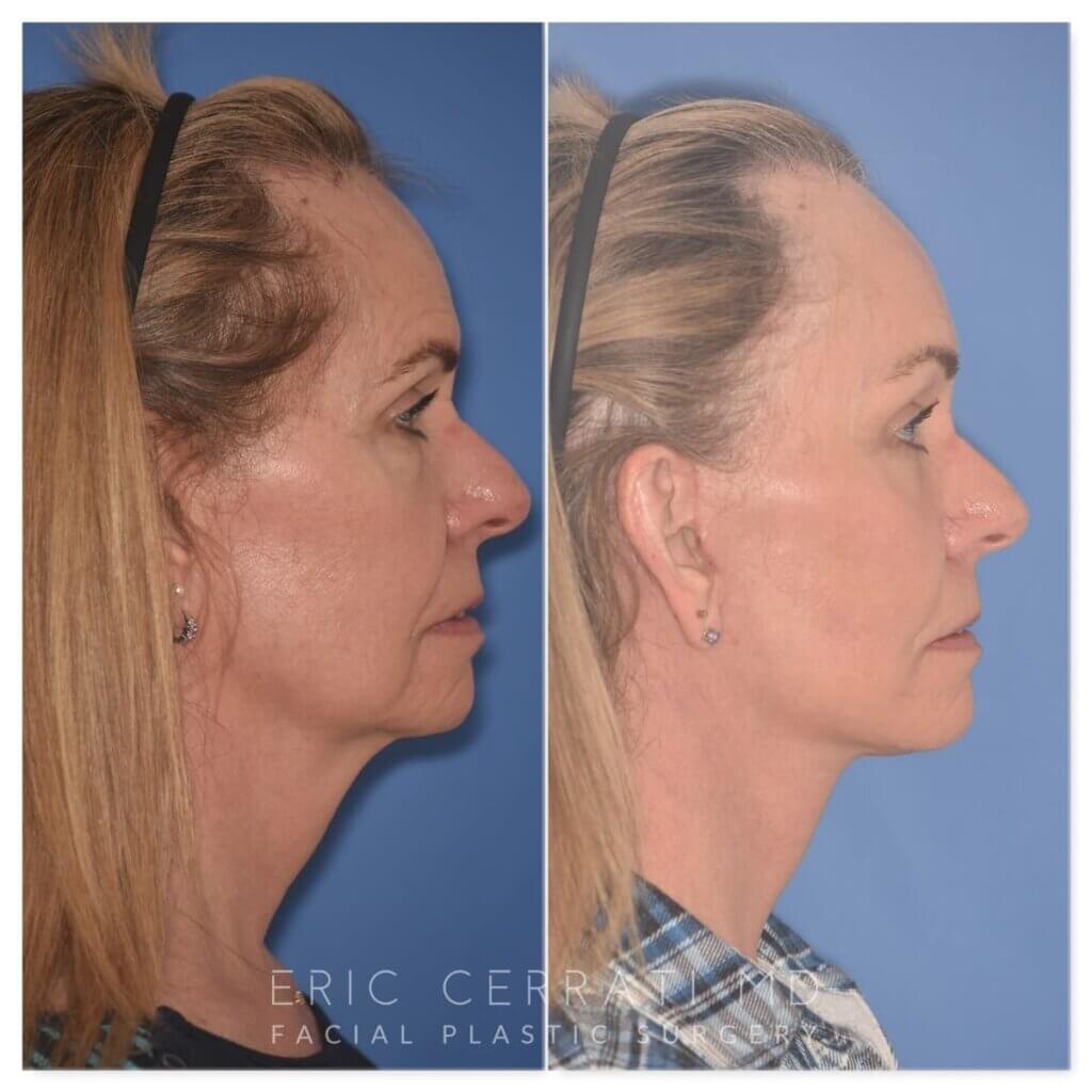 64 YR - 1 Month Postop: Endoscopic Browlift + Facelift + Lower Blepharoplasty + Buccal Fat Reduction + Fat Grafting + Laser Resurfacing