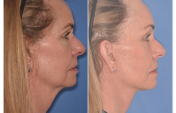 64 YR - 1 Month Postop: Endoscopic Browlift + Facelift + Lower Blepharoplasty + Buccal Fat Reduction + Fat Grafting + Laser Resurfacing