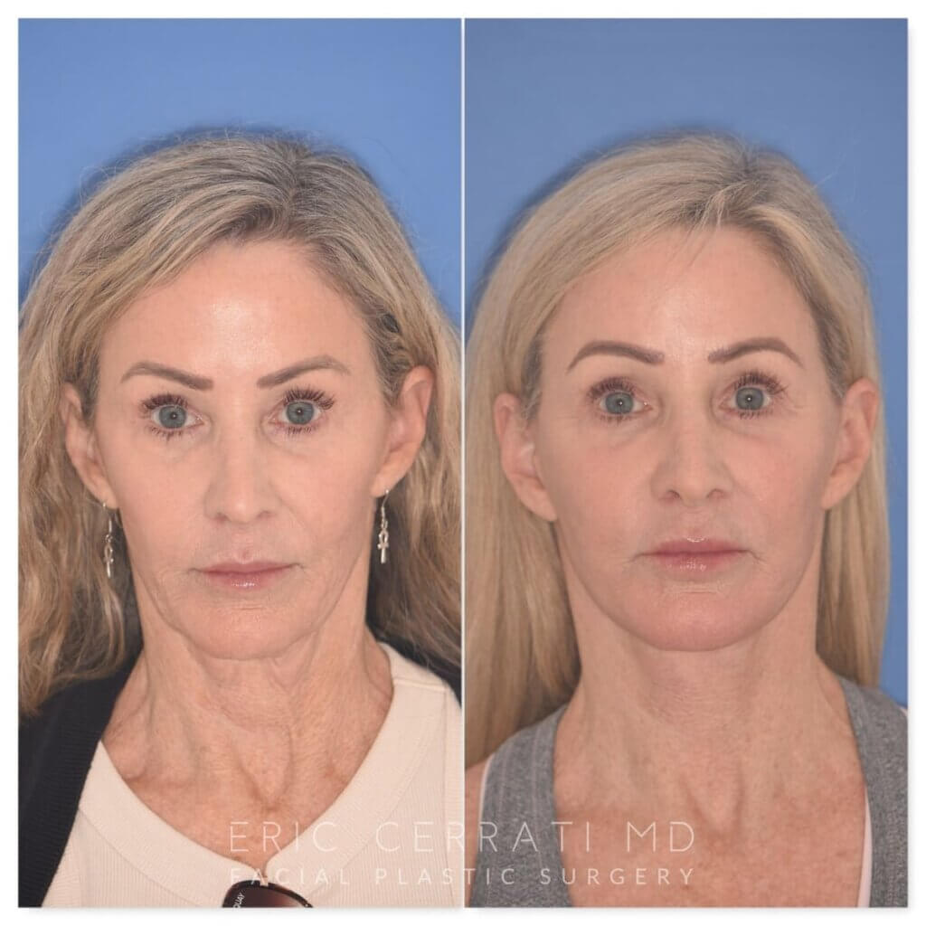 61 YR - 2 Months Postop: Revision Facelift + Fat Grafting + Lower Blepharoplasty + Laser