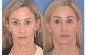 61 YR - 2 Months Postop: Revision Facelift + Fat Grafting + Lower Blepharoplasty + Laser