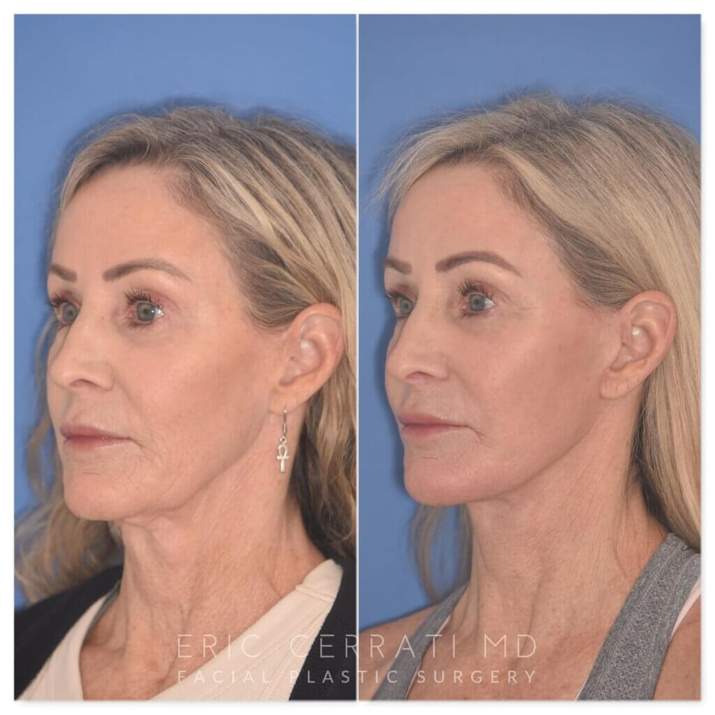 61 YR - 2 Months Postop: Revision Facelift + Fat Grafting + Lower Blepharoplasty + Laser