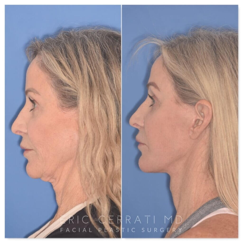 61 YR - 2 Months Postop: Revision Facelift + Fat Grafting + Lower Blepharoplasty + Laser