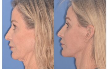 61 YR - 2 Months Postop: Revision Facelift + Fat Grafting + Lower Blepharoplasty + Laser