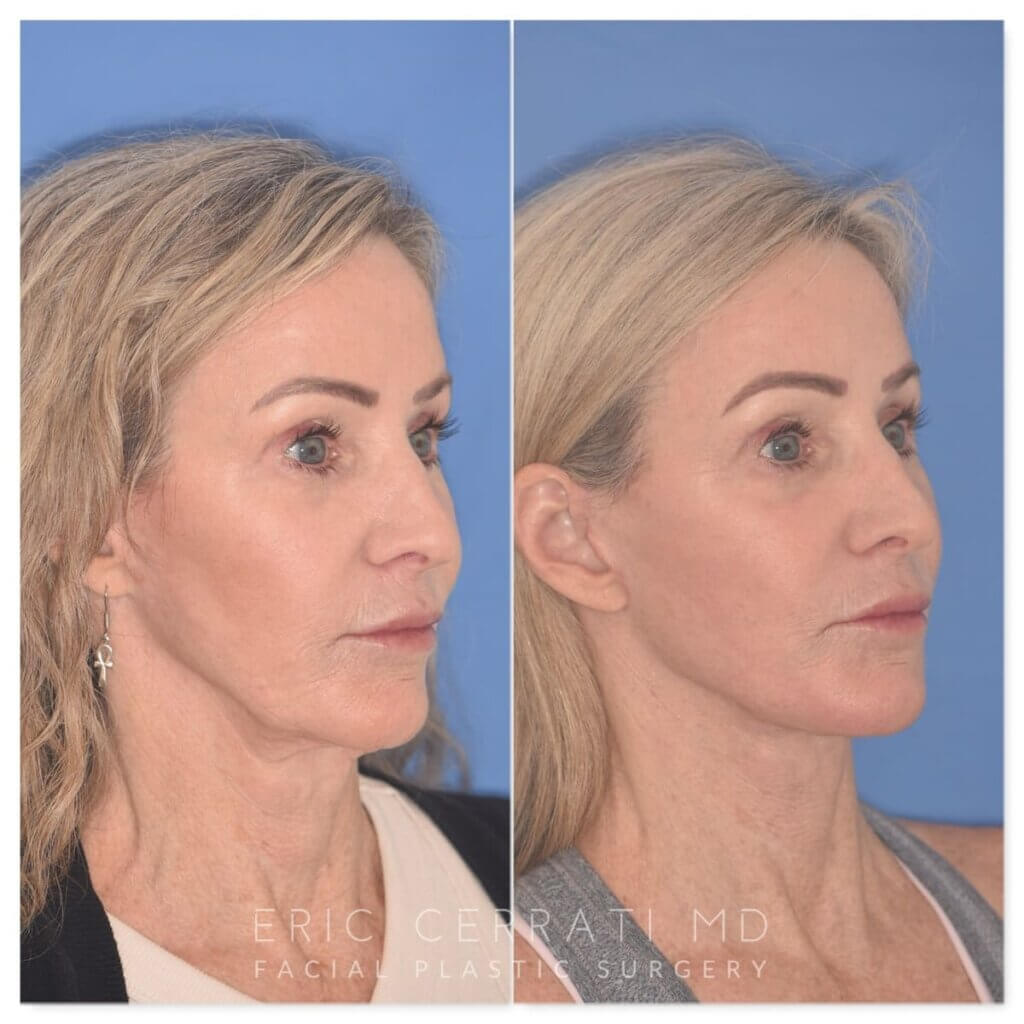 61 YR - 2 Months Postop: Revision Facelift + Fat Grafting + Lower Blepharoplasty + Laser