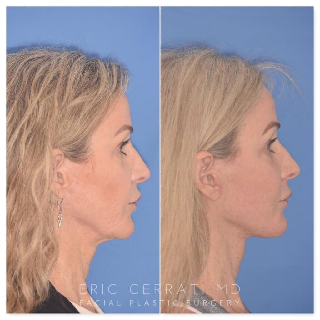 61 YR - 2 Months Postop: Revision Facelift + Fat Grafting + Lower Blepharoplasty + Laser