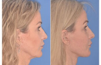 61 YR - 2 Months Postop: Revision Facelift + Fat Grafting + Lower Blepharoplasty + Laser