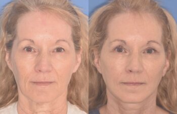 64 YR - 1 Month Postop: Facelift + Upper Blepharoplasty