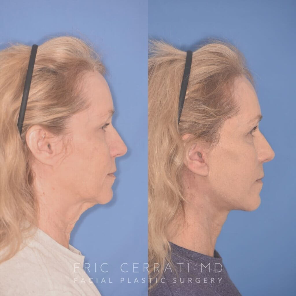 64 YR - 1 Month Postop: Facelift + Upper Blepharoplasty