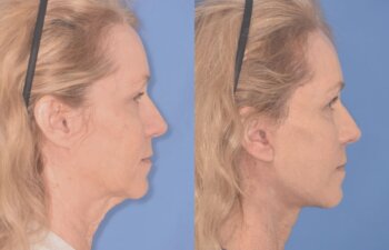 64 YR - 1 Month Postop: Facelift + Upper Blepharoplasty