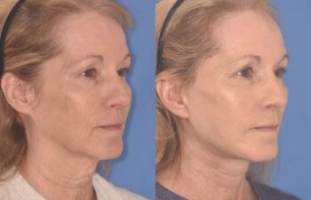 64 YR - 1 Month Postop: Facelift + Upper Blepharoplasty