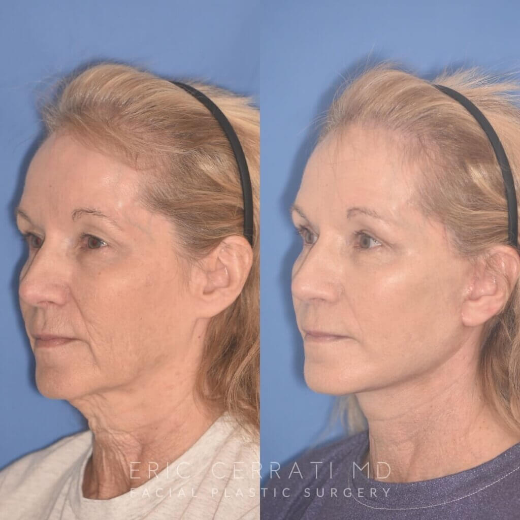 64 YR - 1 Month Postop: Facelift + Upper Blepharoplasty