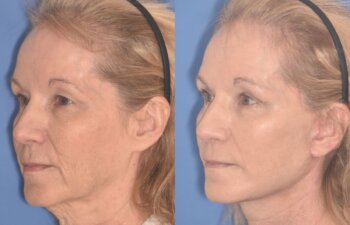 64 YR - 1 Month Postop: Facelift + Upper Blepharoplasty