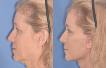 64 YR - 1 Month Postop: Facelift + Upper Blepharoplasty