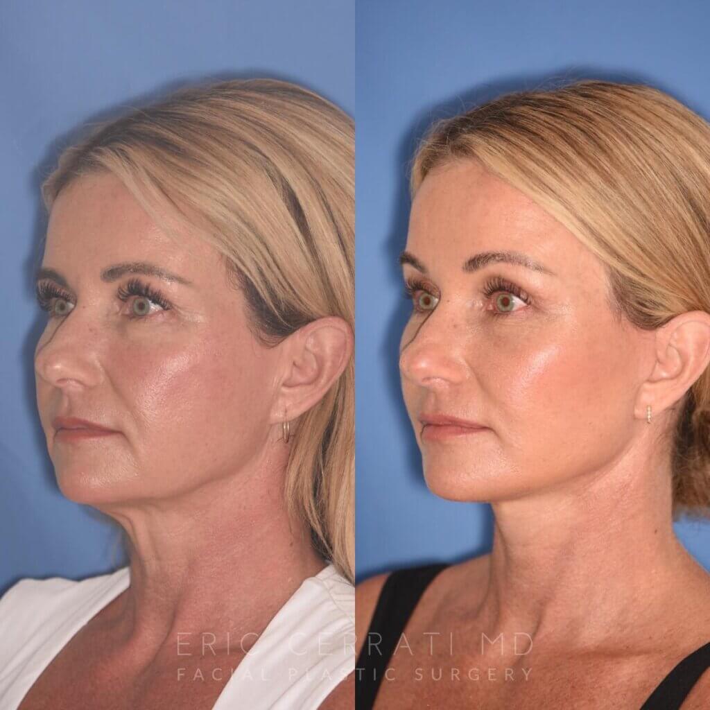 51 YR - 1 Month Postop: Endoscopic Browlift + Facelift