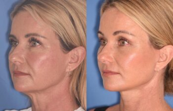 51 YR - 1 Month Postop: Endoscopic Browlift + Facelift