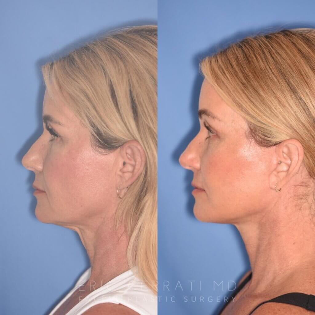 51 YR - 1 Month Postop: Endoscopic Browlift + Facelift
