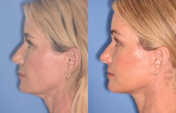 51 YR - 1 Month Postop: Endoscopic Browlift + Facelift