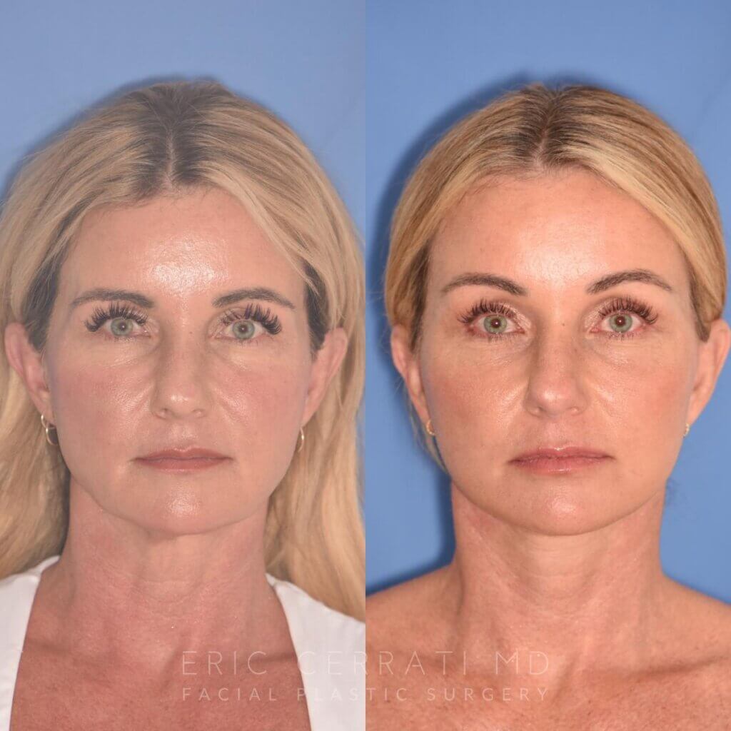 51 YR - 1 Month Postop: Endoscopic Browlift + Facelift