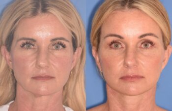 51 YR - 1 Month Postop: Endoscopic Browlift + Facelift