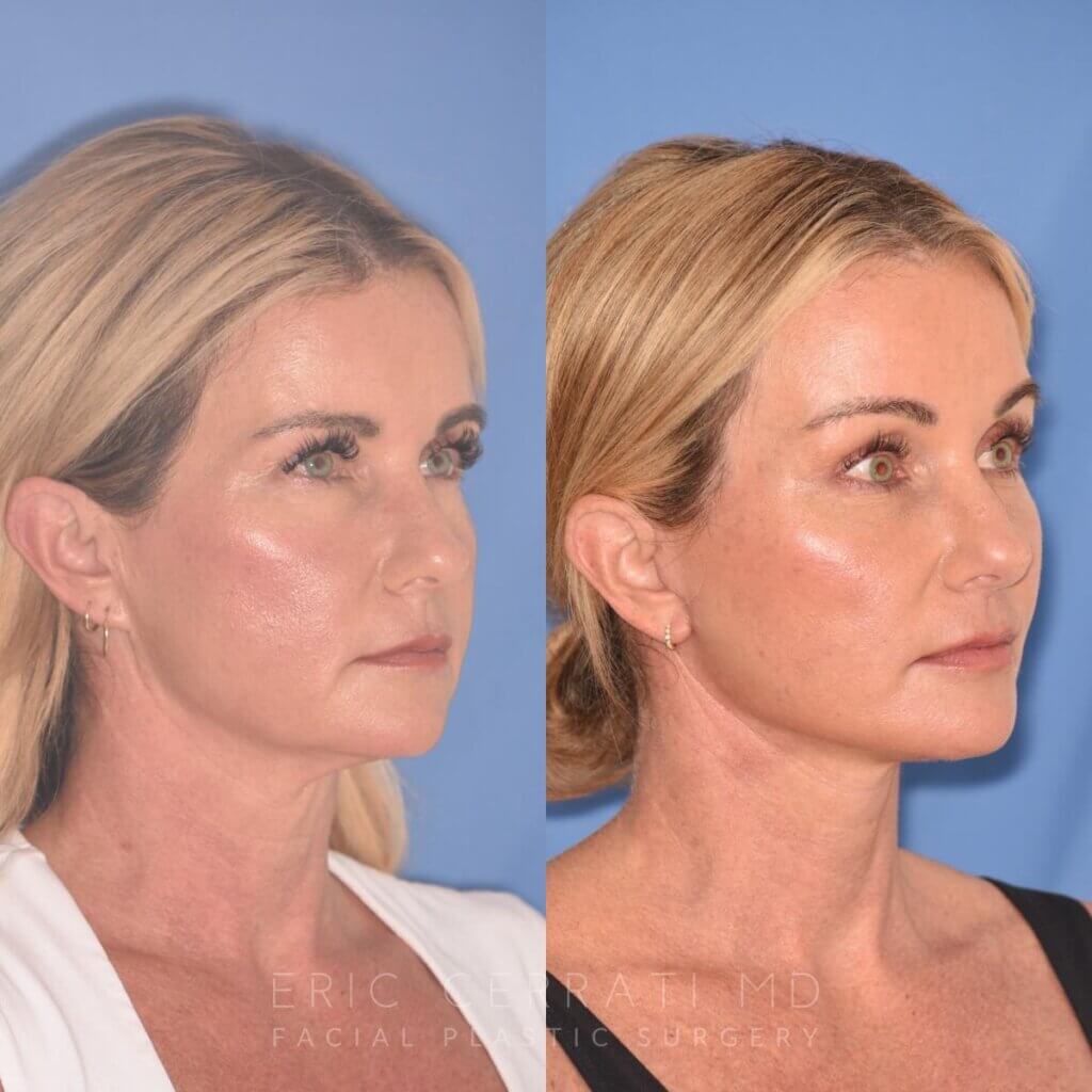 51 YR - 1 Month Postop: Endoscopic Browlift + Facelift